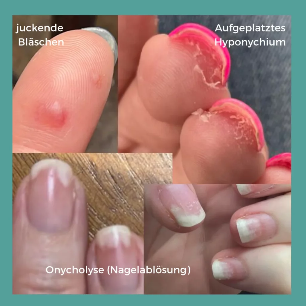 Verschiedene Formen einer allergischen Reaktion auf HEMA, Di-HEMA und HPMA
